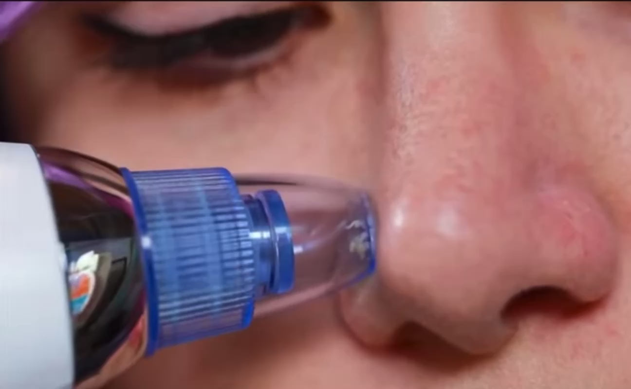 Extractor de Espinillas con Liquido